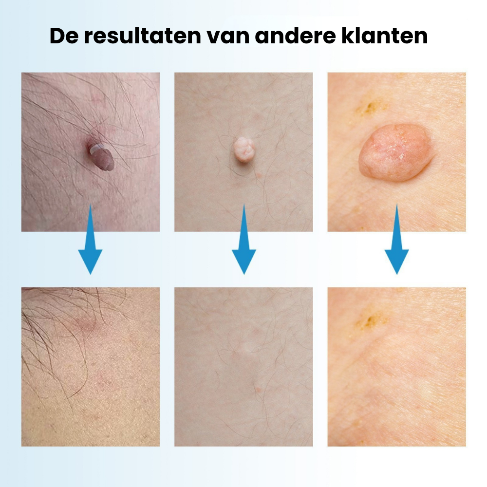 SilkaPen™  | Nauwkeurige Verwijdering van Steelwratjes