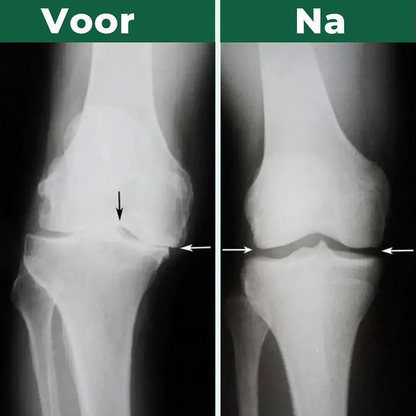 Kneemax™ - Kniebandage