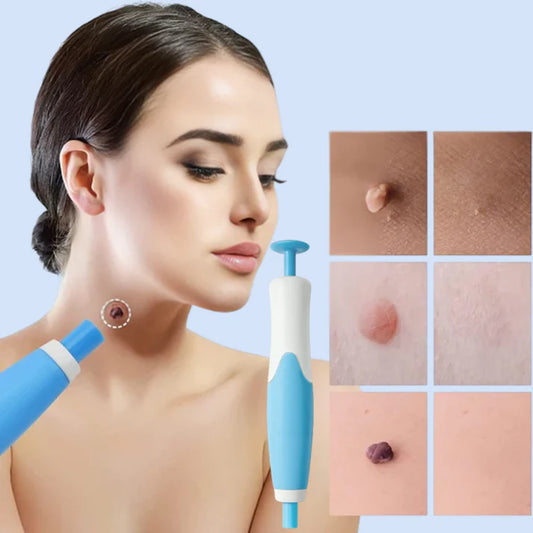 SilkaPen™  | Nauwkeurige Verwijdering van Steelwratjes